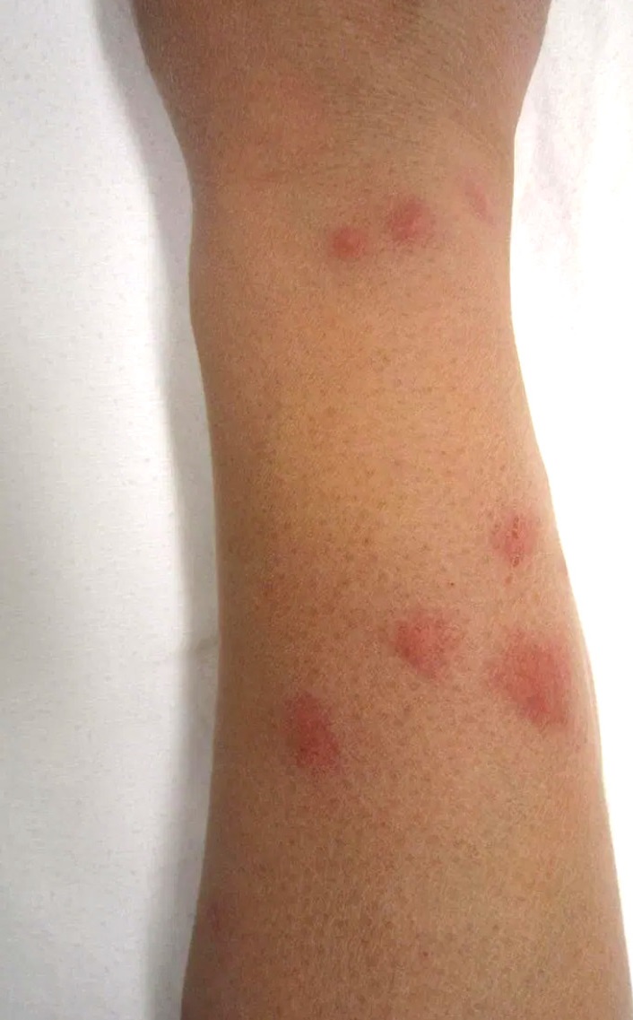what do bed bug bites look like?